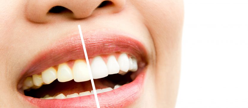 7 Simple Hacks to Naturally Whiten Your Teeth at Home
