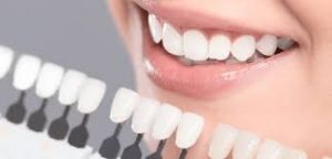 Teeth whitening scales
